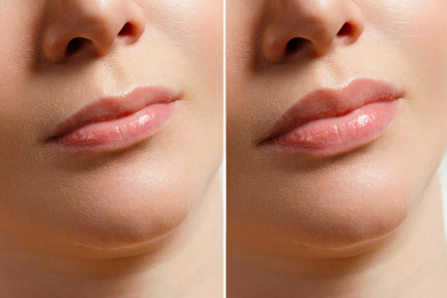 The Evolution Of Lip Enhancements