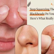 blackheads on nose