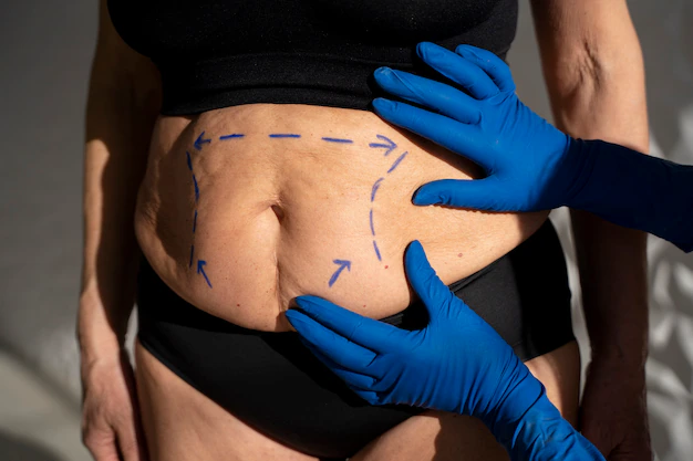 Coolsculpting