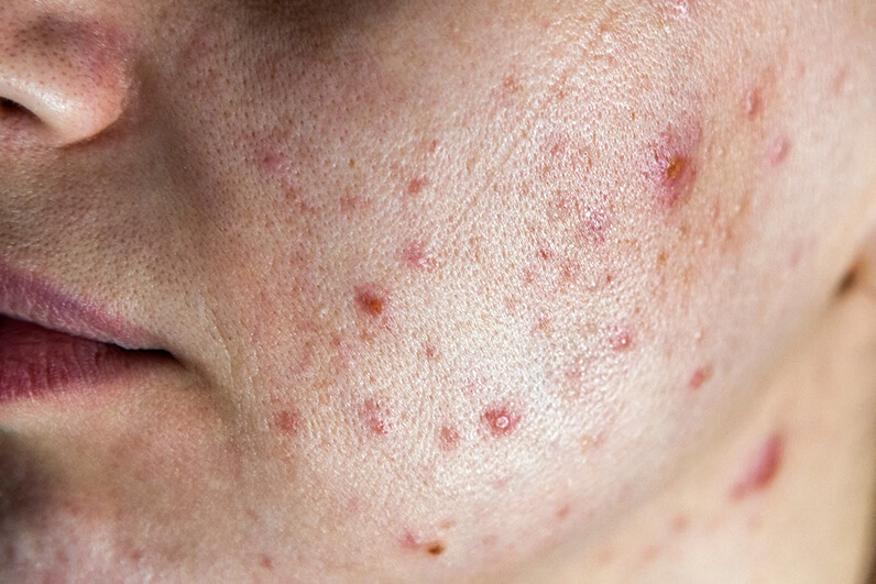 La Roche Posay vs Neutrogena For Acne Prone Skin