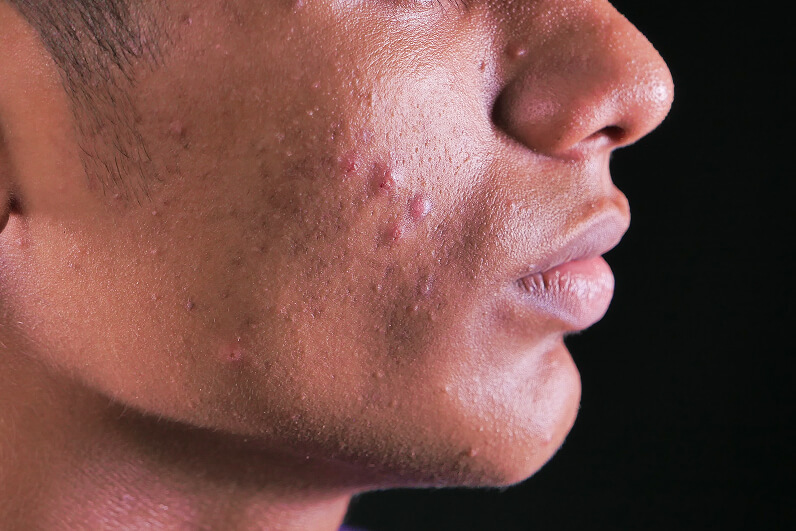 The Reality Of Gen Z Men's Skin In India